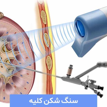 راهنمای کامل سنگ شکنی کلیه در سال 1404