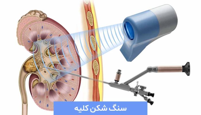 سنگ شکنی کلیه