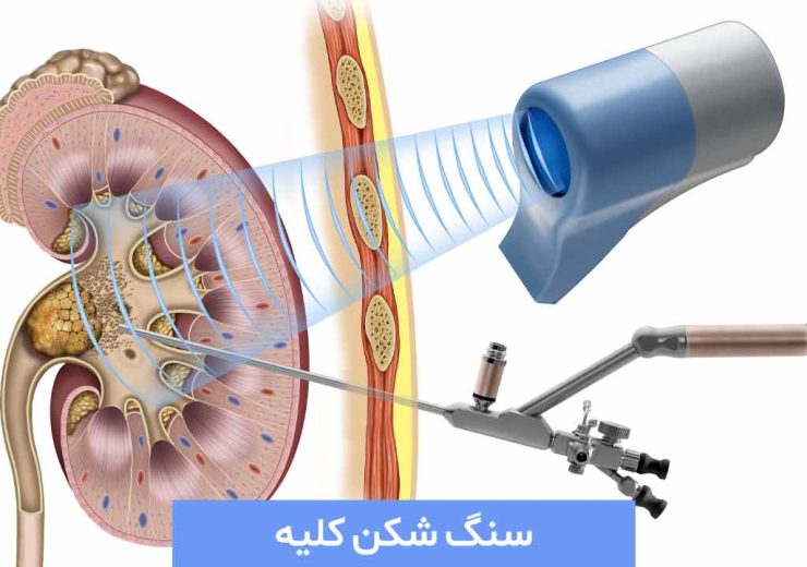 سنگ شکنی کلیه