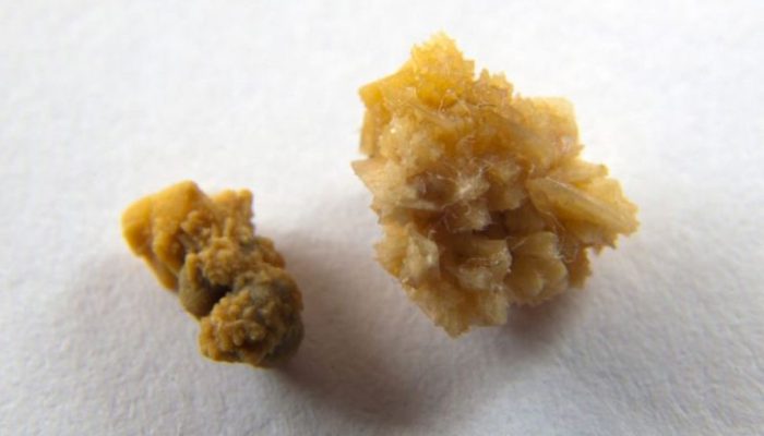 سنگ کلیه