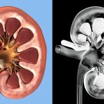 راهنمای 0 تا 100 عمل سنگ شکنی TUL کلیه جدیدترین روش خرد کردن سنگ‌ها