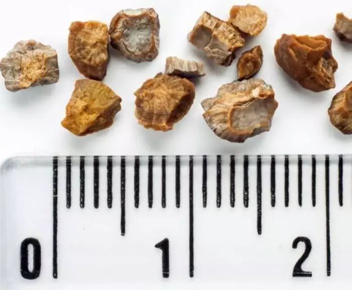 عمل سنگ شکنی در بیمارستان مادر مشهد