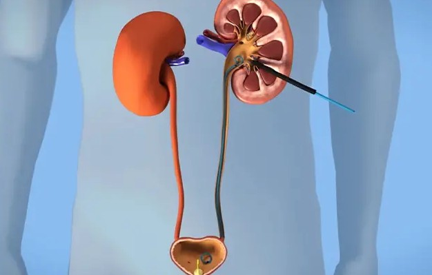 عمل سنگ شکنی